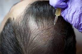 Can Stem Cell Hair Growth Serum Treat Hair Loss?